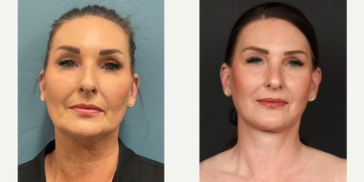 Case 7861 - 45-54 year old woman treated with Facelift, Lower Facelift, SMAS Facelift