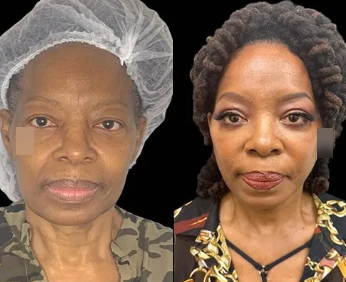 Case 7864 - 66 year old woman treated with Neck Lift, Facelift
