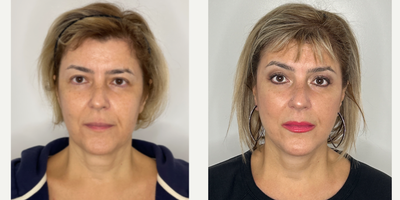 Case 7865 - 55-64 year old woman treated with Facelift, Neck Lift, CO2 Laser