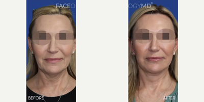 Case 7866 - Woman treated with Facelift, CO2 Laser