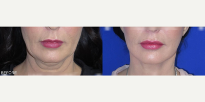 Case 7867 - Woman treated with Facelift