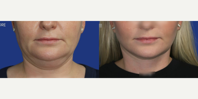 Case 7868 - Woman treated with Facelift