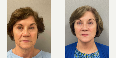 Case 7871 - 65 year old woman treated with NaturalLift