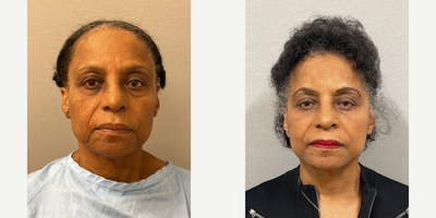 Case 7872 - 71 year old woman treated with NaturalLift, Eyelid Surgery, Facial Fat Transfer