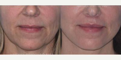 Case 7876 - Woman treated with Facelift