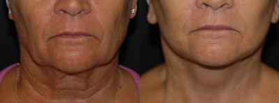 Case 7878 - Woman treated with Facelift, Neck Lift