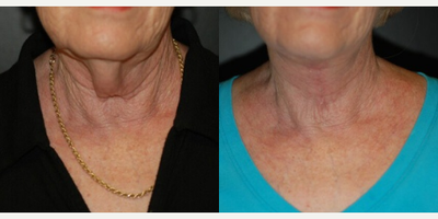 Case 7879 - Woman treated with Facelift, Neck Lift