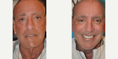 Case 7880 - Man treated with Facelift