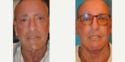 Case 7881 - Man treated with Facelift