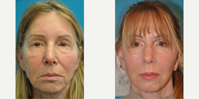 Case 7882 - Woman treated with Facelift