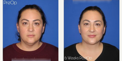Case 7883 - Woman treated with Facelift, Neck Lift