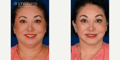 Case 7885 - Woman treated with Facelift