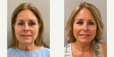 Case 7887 - 62 year old woman treated with NaturalLift