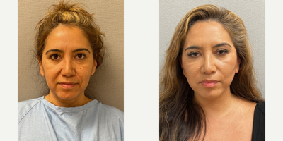 Case 7888 - 51 year old woman treated with NaturalLift