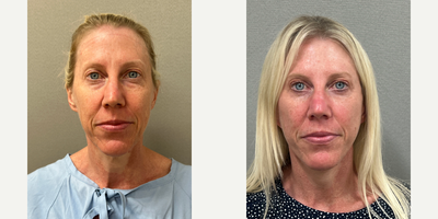Case 7889 - 51 year old woman treated with NaturalLift, Lower eyelid blepharoplasty