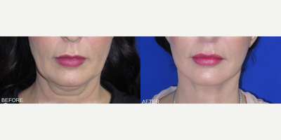 Case 7890 - Woman treated with Facelift