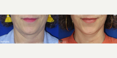 Case 7891 - Woman treated with Facelift