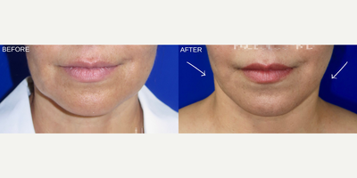 Case 7892 - Woman treated with Facelift