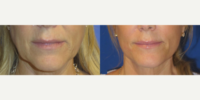 Case 7893 - Woman treated with Facelift
