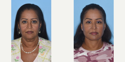 Case 7898 - Woman treated with Facelift