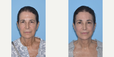 Case 7899 - Woman treated with Facelift