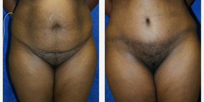 Case 79 - 35-44 year old woman treated with Tummy Tuck