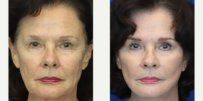 Case 7900 - Woman treated with Facelift