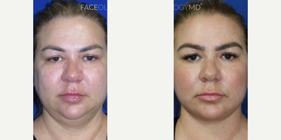 Case 7901 - Woman treated with Facelift