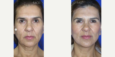 Case 7902 - Woman treated with Facelift