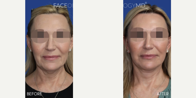 Case 7903 - Woman treated with Facelift, CO2 Laser