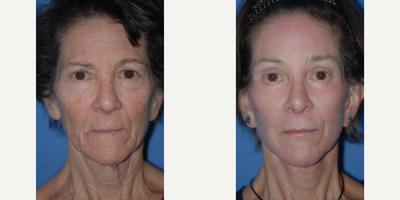 Case 7905 - Woman treated with Facelift