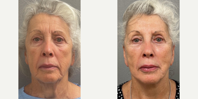 Case 7906 - Woman treated with NaturalLift