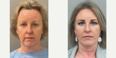 Case 7907 - Woman treated with NaturalLift