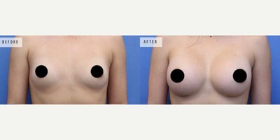Case: 7911 - before and after photo of Woman treated with Breast Augmentation, Breast Implants by Jason Altman, MD