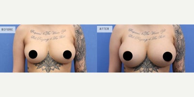Case: 7912 - before and after photo of Woman treated with Breast Augmentation, Breast Implants by Jason Altman, MD