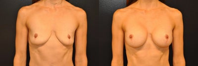 Case: 7913 - before and after photo of Woman treated with Breast Augmentation, Breast Implants by Robert L. Steely, MD, FACS