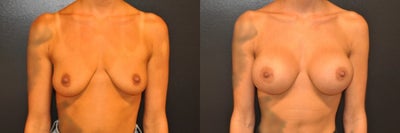 Case: 7916 - before and after photo of Woman treated with Breast Augmentation, Breast Implants by Robert L. Steely, MD, FACS