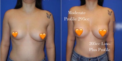 Case: 7919 - before and after photo of Woman treated with Breast Augmentation, Breast Implants by Shahram Salemy, MD, FACS
