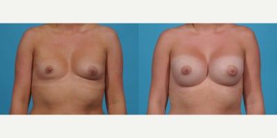 Case 7920 - 25-34 year old woman treated with Breast Implants, Breast Augmentation, Inspira Breast Implants, Natrelle Breast Implants