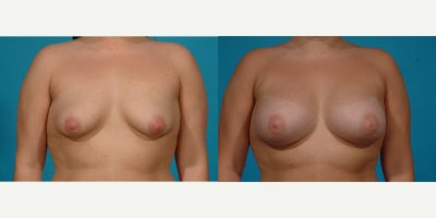Case 7922 - 25-34 year old woman treated with Breast Implants, Natrelle Breast Implants, Breast Augmentation, Inspira Breast Implants
