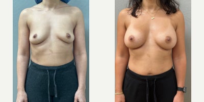 Case 7924 - Woman treated with Breast Augmentation