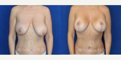 Case 7925 - Woman treated with Breast Augmentation