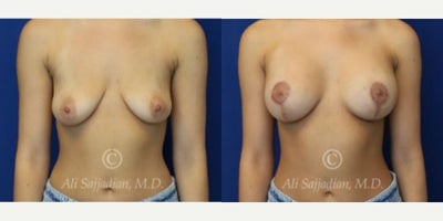 Case 7926 - Woman treated with Breast Augmentation