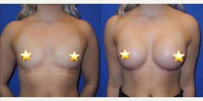 Case 7930 - Woman treated with Breast Augmentation