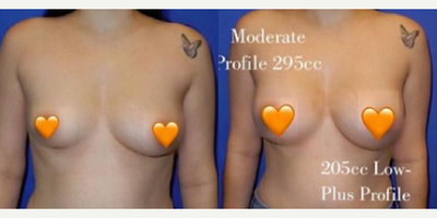 Case 7932 - Woman treated with Breast Augmentation