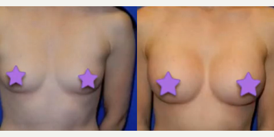 Case 7933 - Woman treated with Breast Augmentation