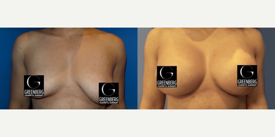 Case 7935 - Woman treated with Breast Augmentation