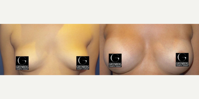 Case 7936 - Woman treated with Breast Augmentation