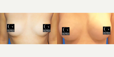 Case 7937 - Woman treated with Breast Augmentation