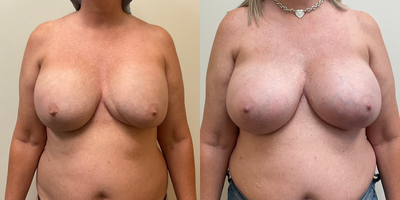 Case 7944 - Woman treated with Breast Augmentation
